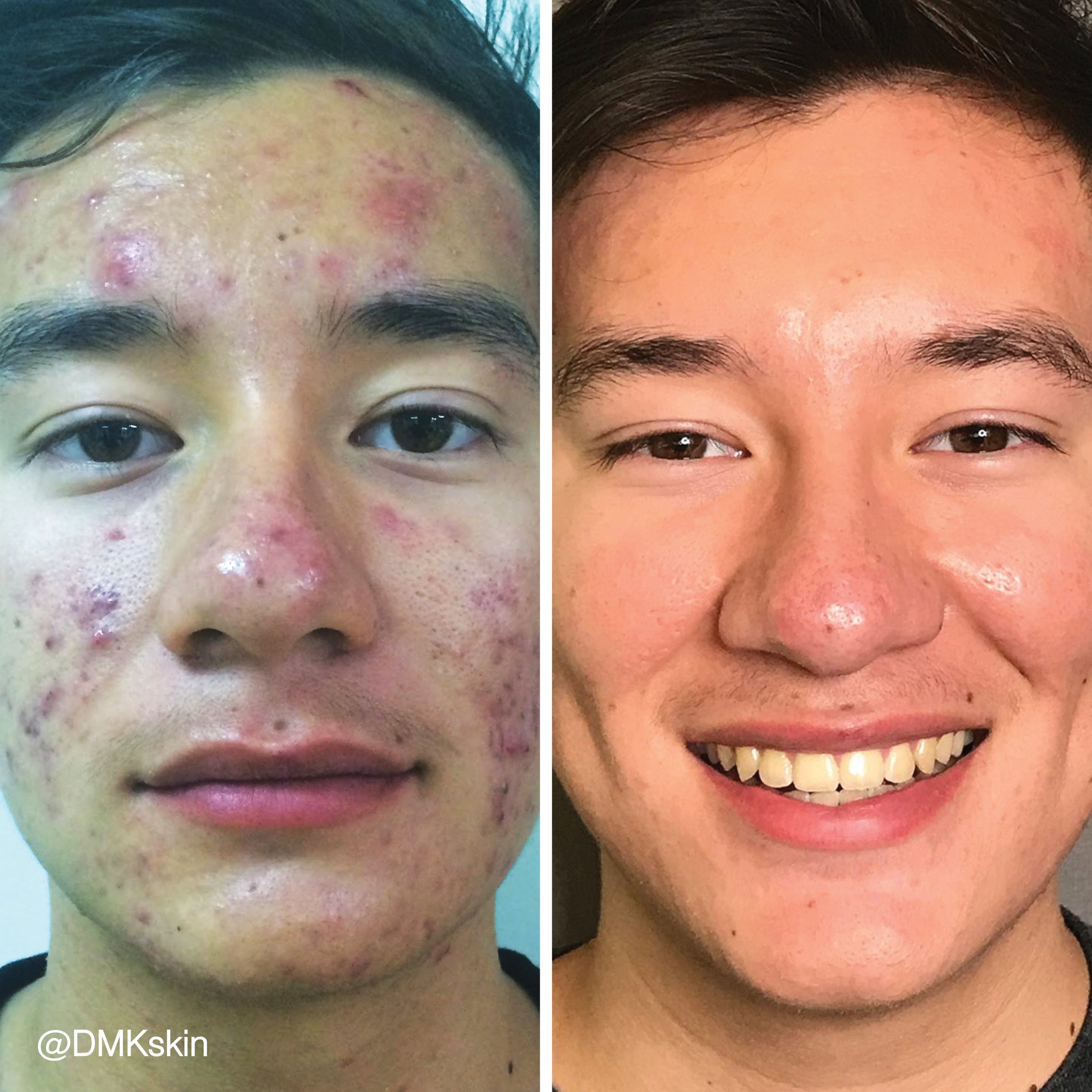 Uncover the “Why” of Your Acne, and You’ll Soon Uncover Healthier, More Beautiful Skin