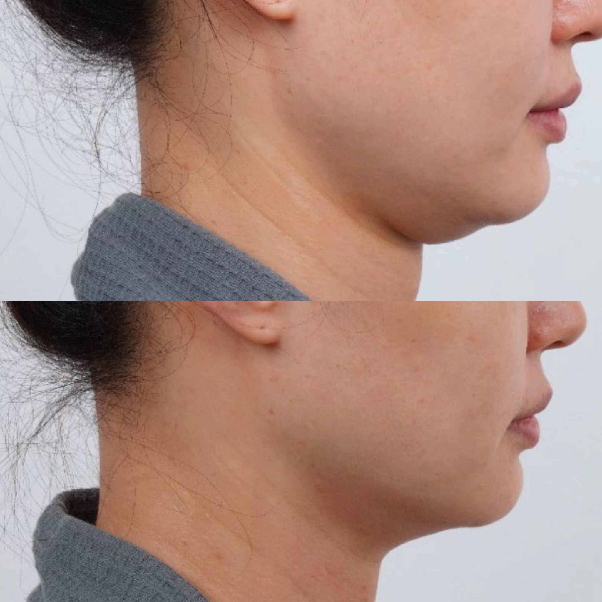 Ultraformer MPT HIFU