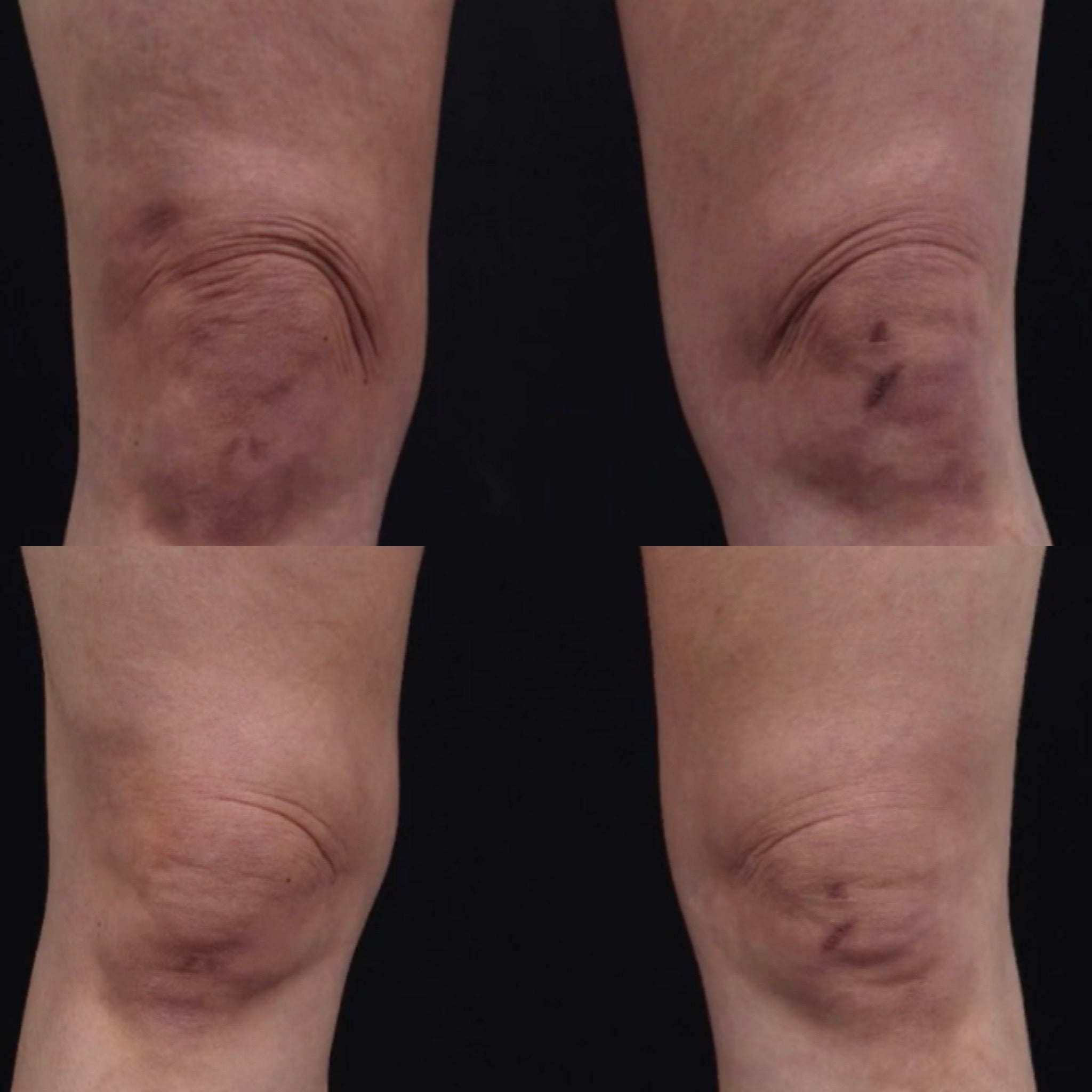 Ultraformer MPT HIFU for Body