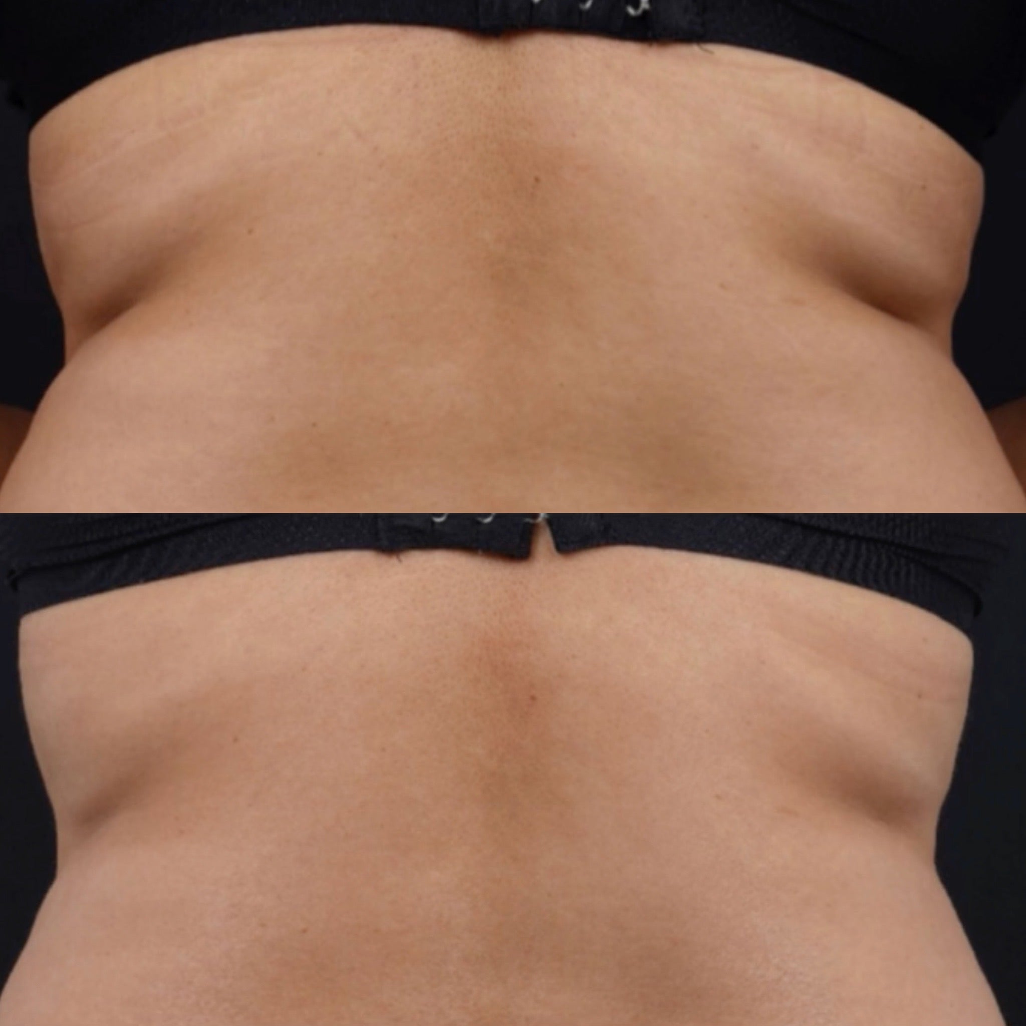 Ultraformer MPT HIFU for Body