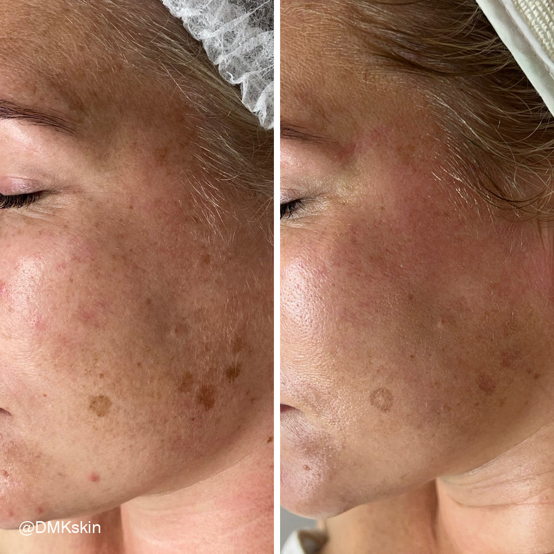 DMK Facial - One day only (Thurs 3rd Sept)