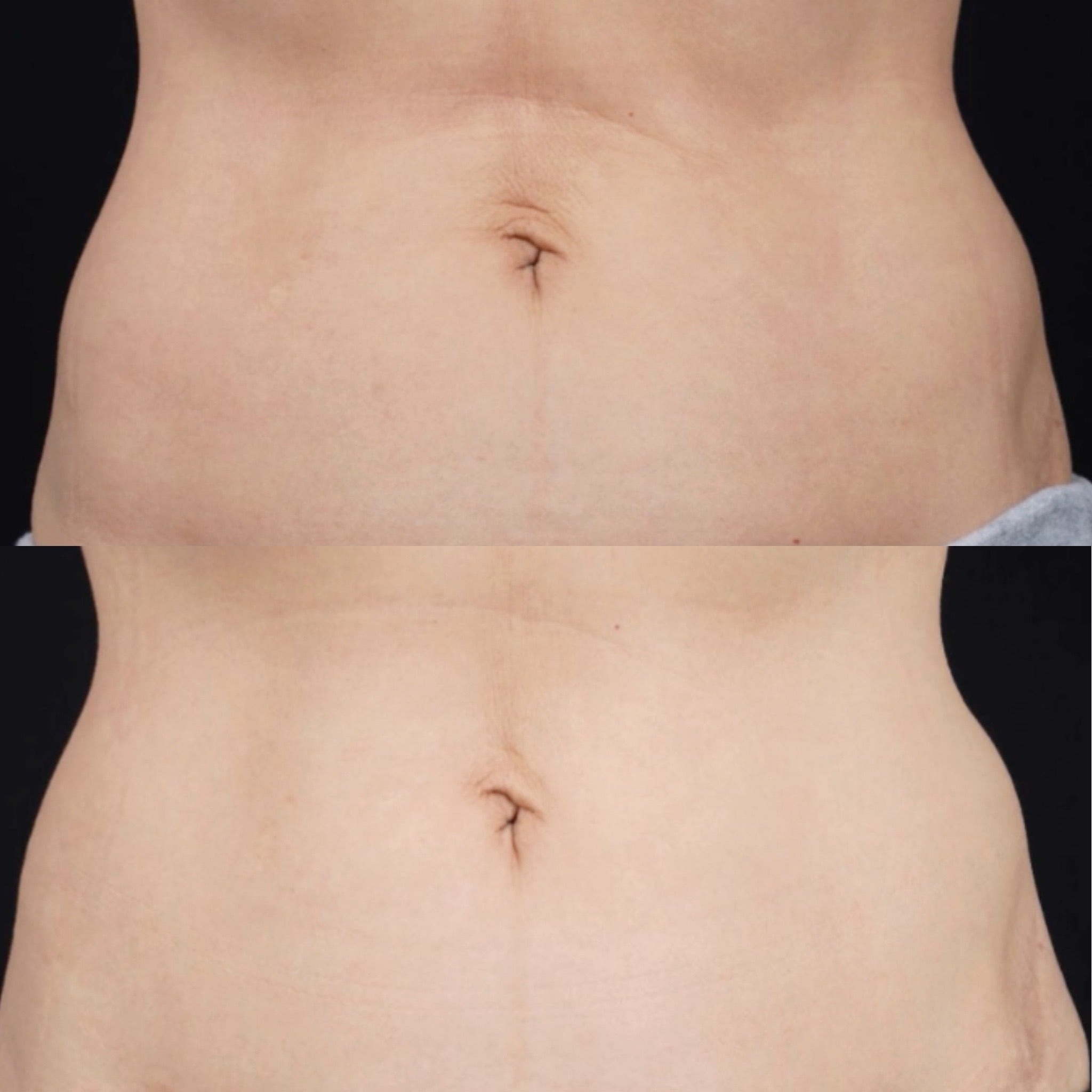 Ultraformer MPT HIFU for Body