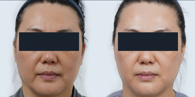 Ultraformer MPT HIFU