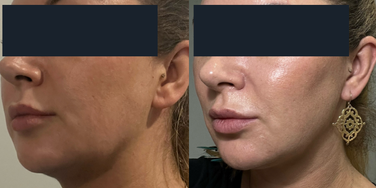 Ultraformer MPT HIFU