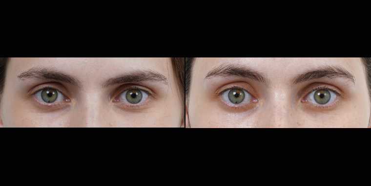 Ultraformer MPT HIFU