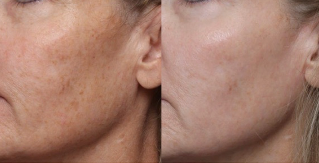 Before and after comparison of facial skin treatment showing reduced blemishes.