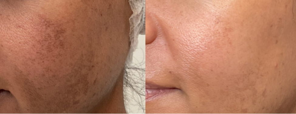 Before and after comparison of skin treatment on a person's face, showing improvement over 4 months.