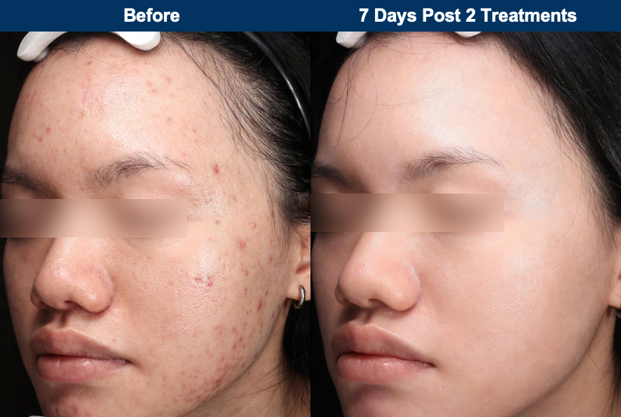 Ultraclear® Laser