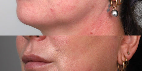 Signature Lower Face Lift - Ultraformer MPT