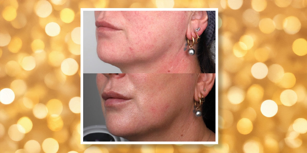 Signature Lower Face Lift - Ultraformer MPT