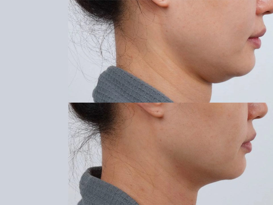 Jawline Definition