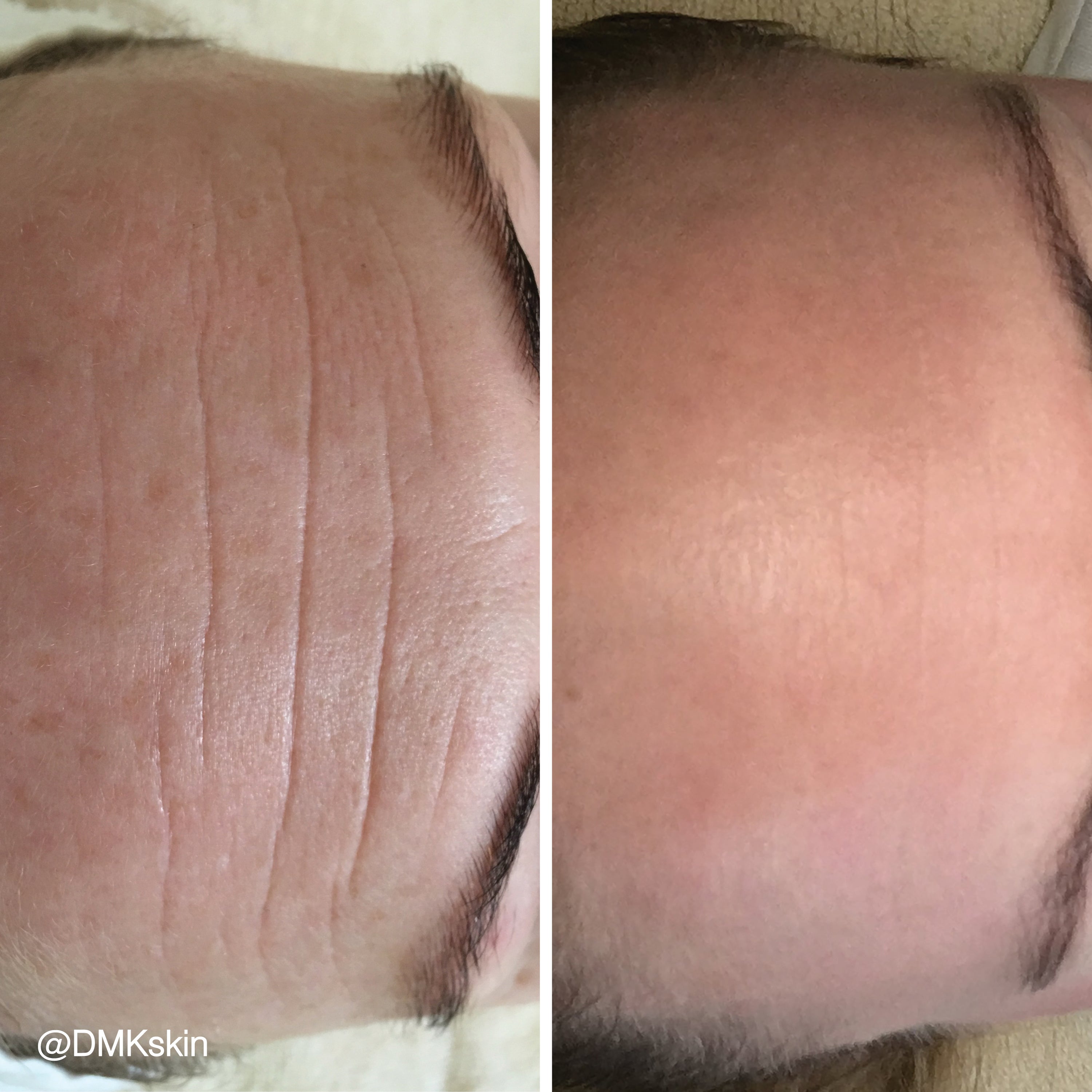 DMK Enzyme Facial - Level 4