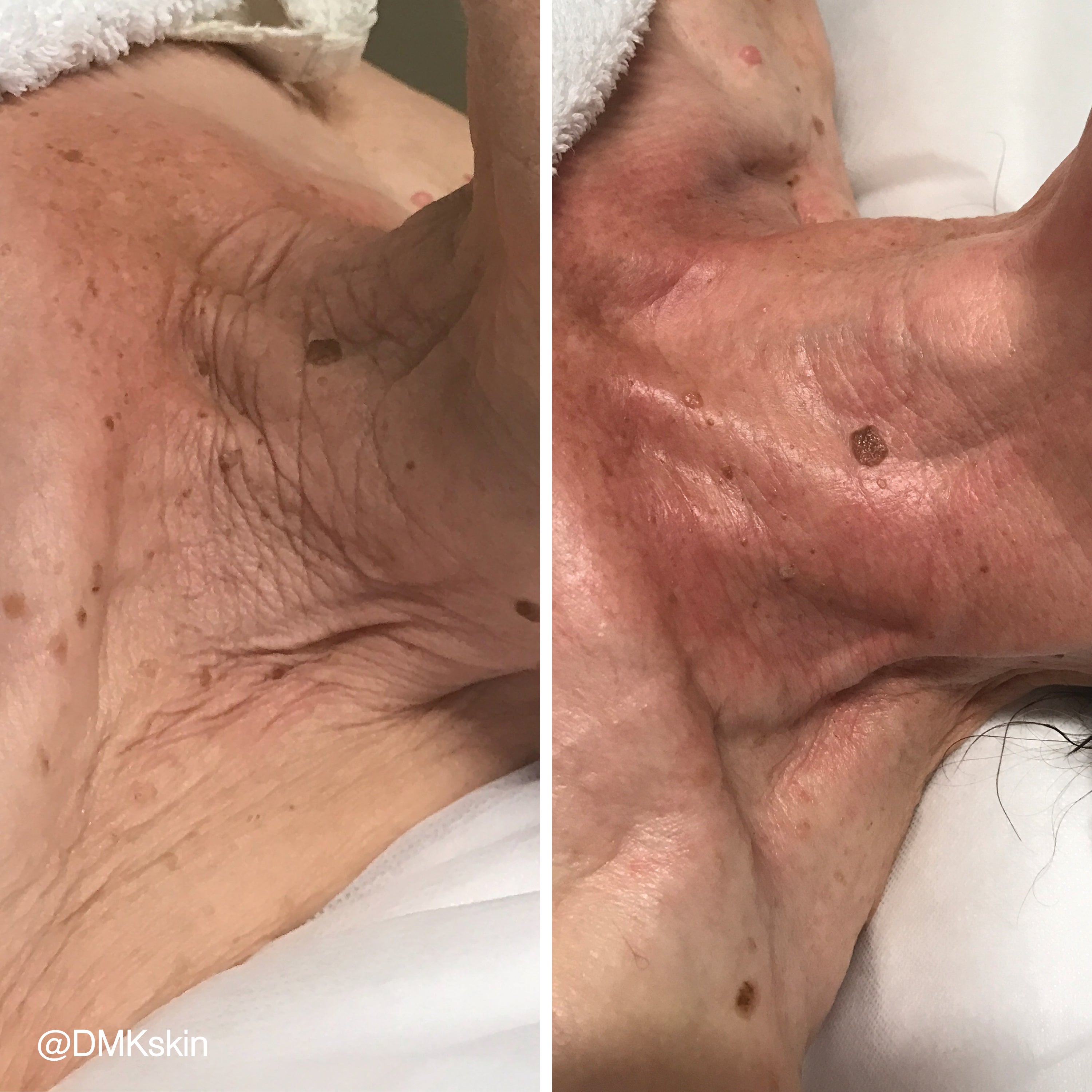 DMK Enzyme Facial - Level 4