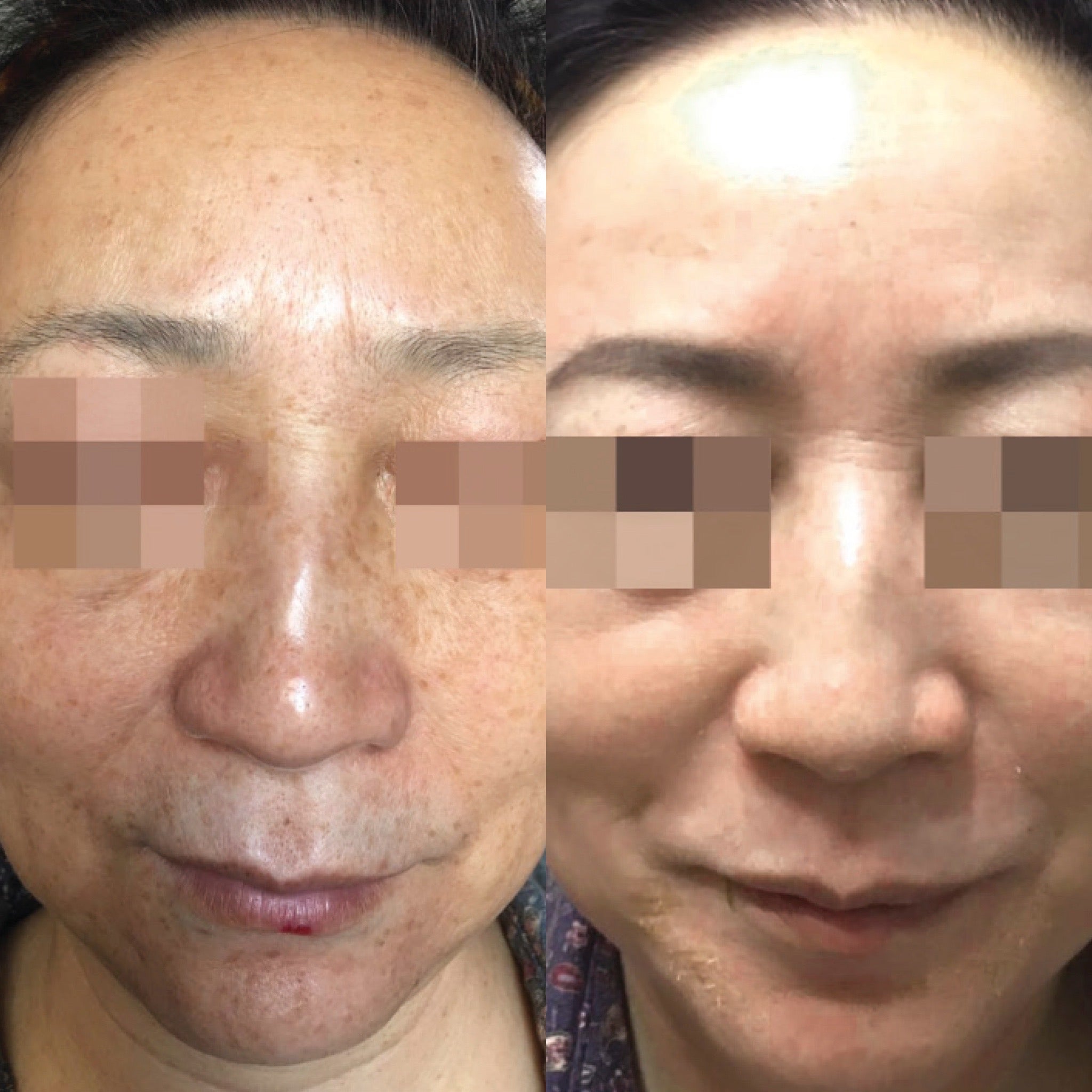 Cosmelan Pigmentation Treatment