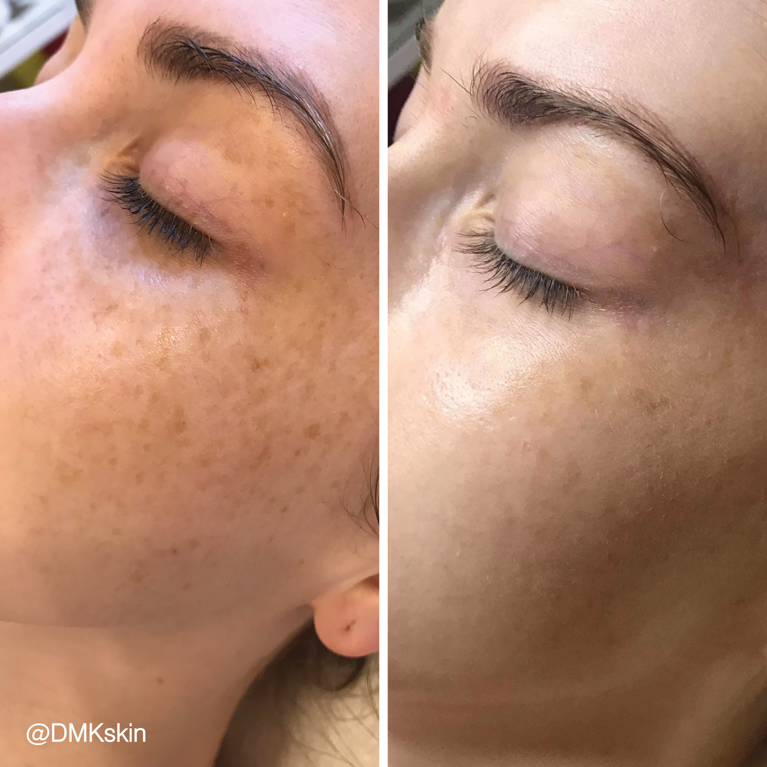 DMK Enzyme Facial - Level 4