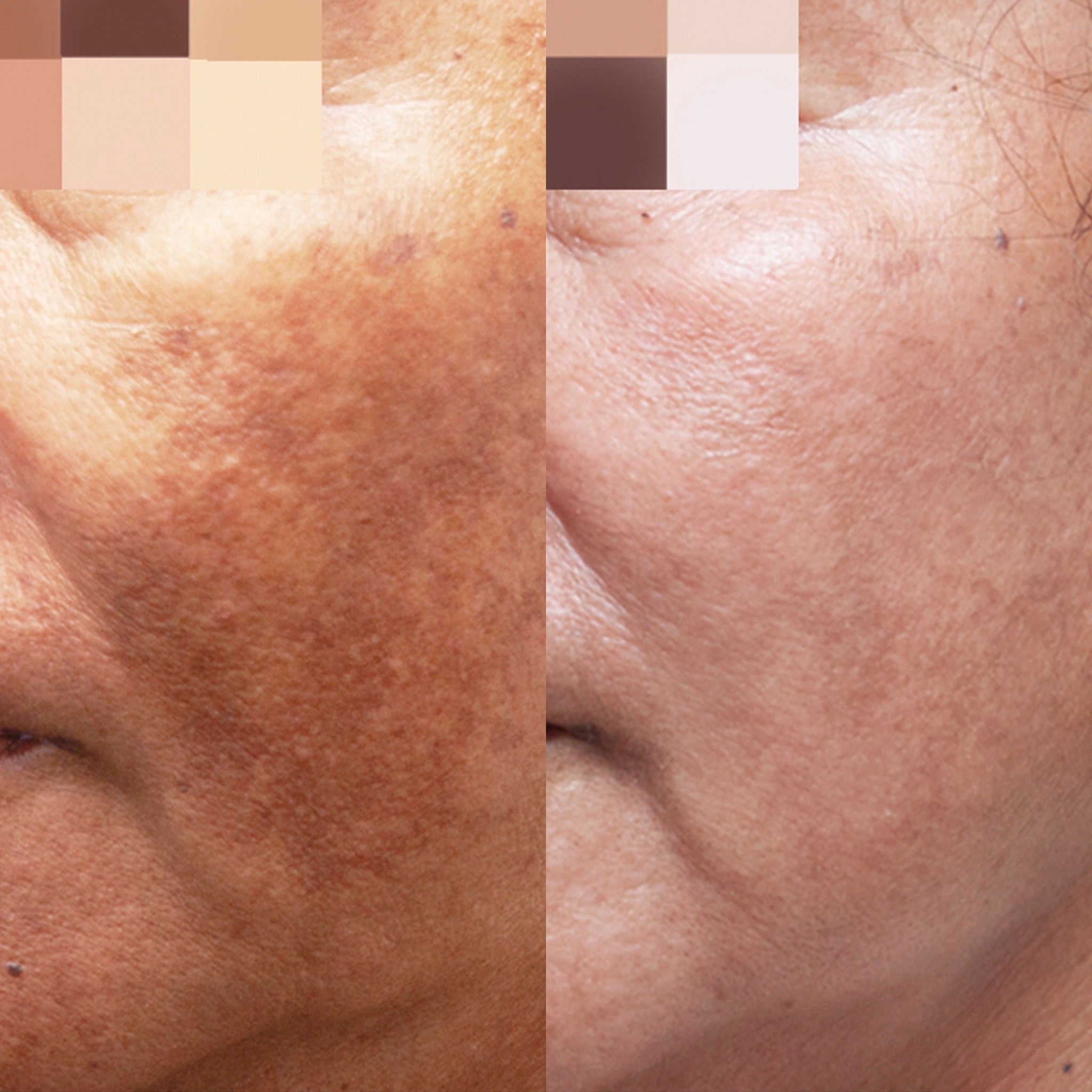 Cosmelan Pigmentation Treatment
