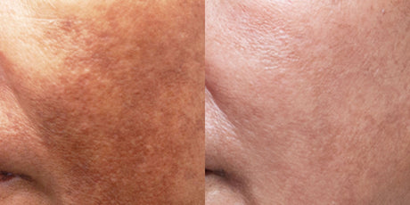Cosmelan Pigmentation Treatment