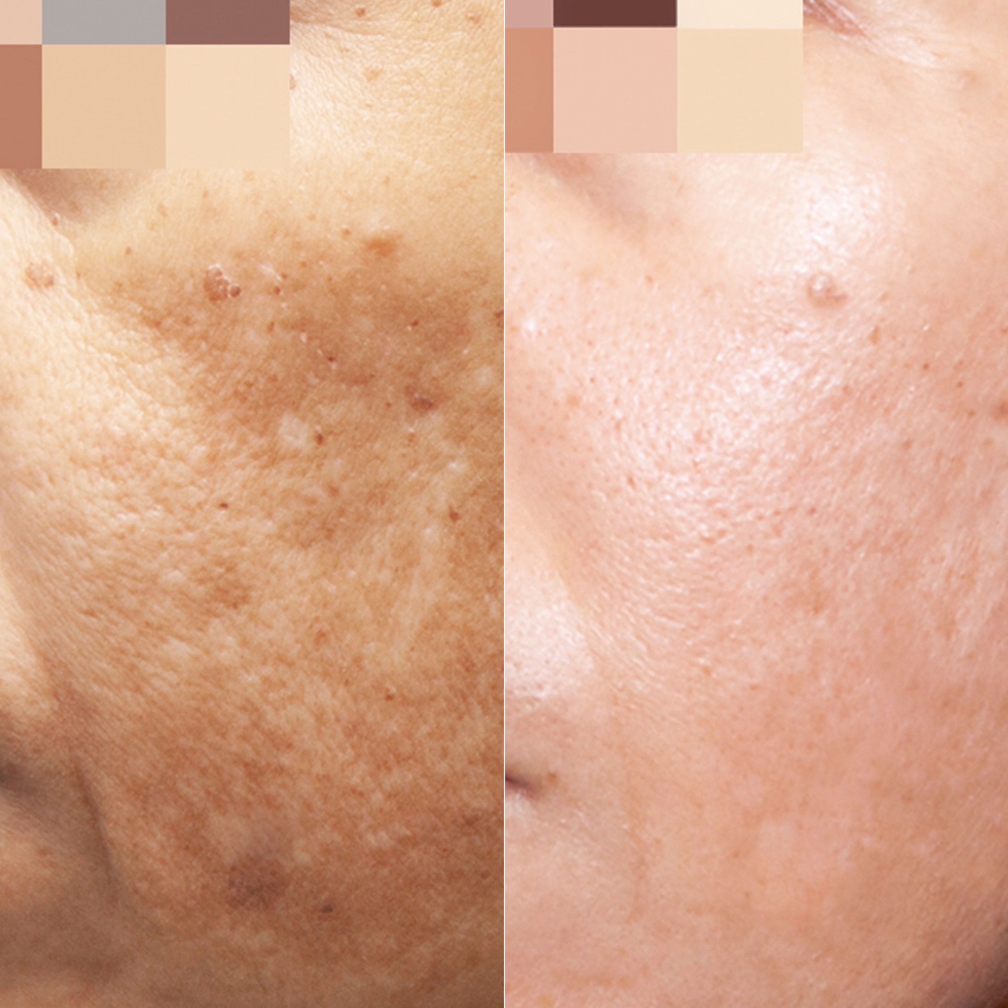 Cosmelan Pigmentation Treatment