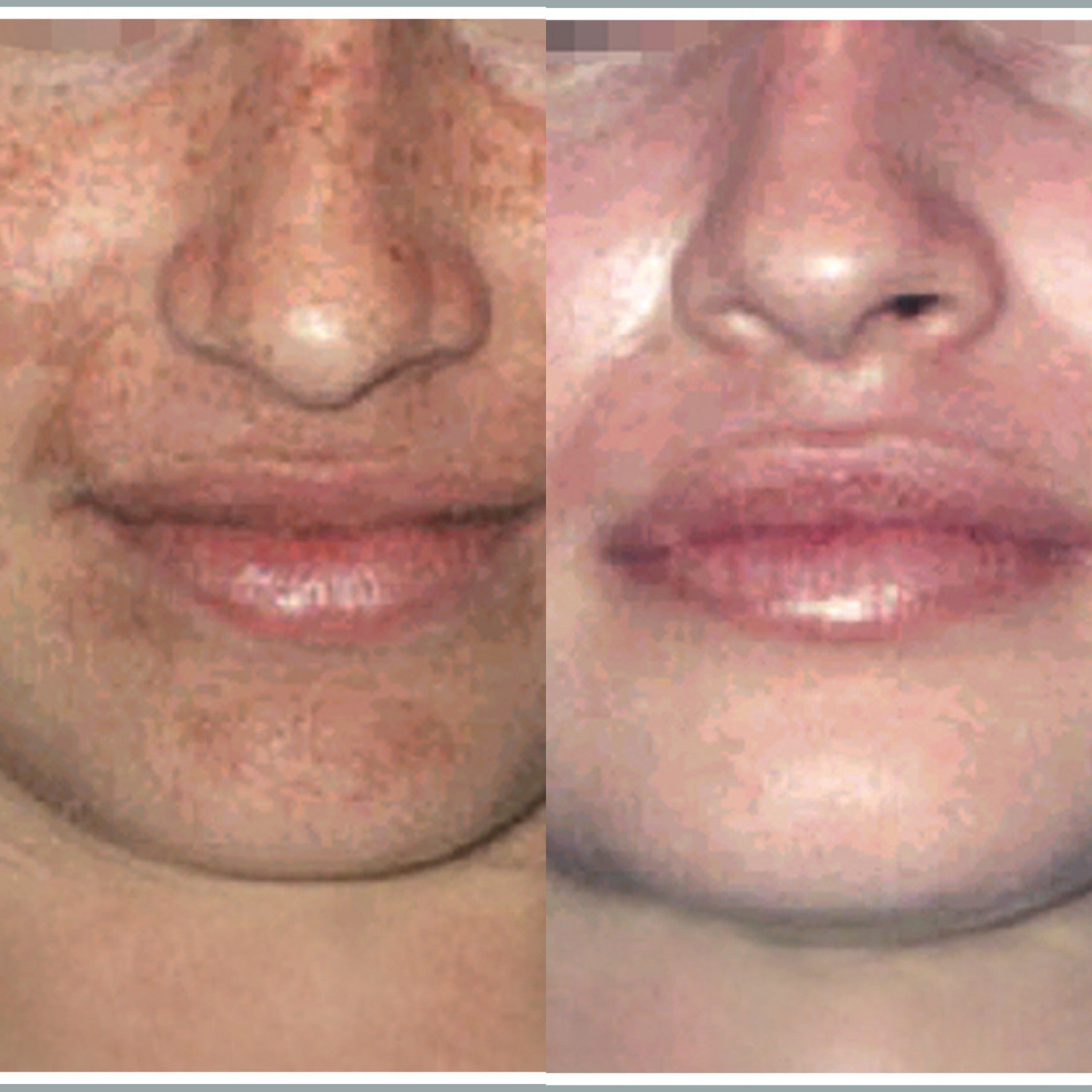 Cosmelan Pigmentation Treatment