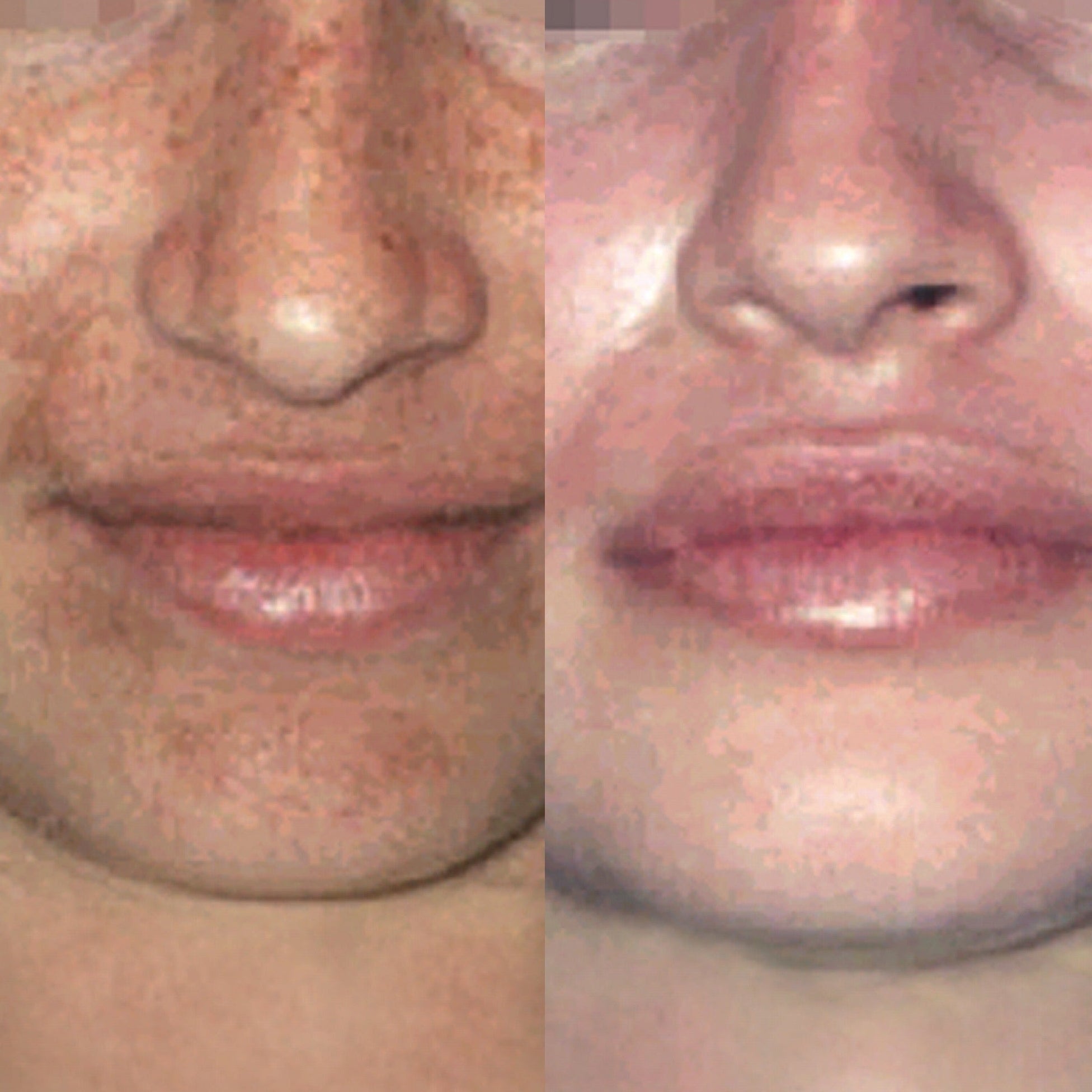 Cosmelan Pigmentation Treatment