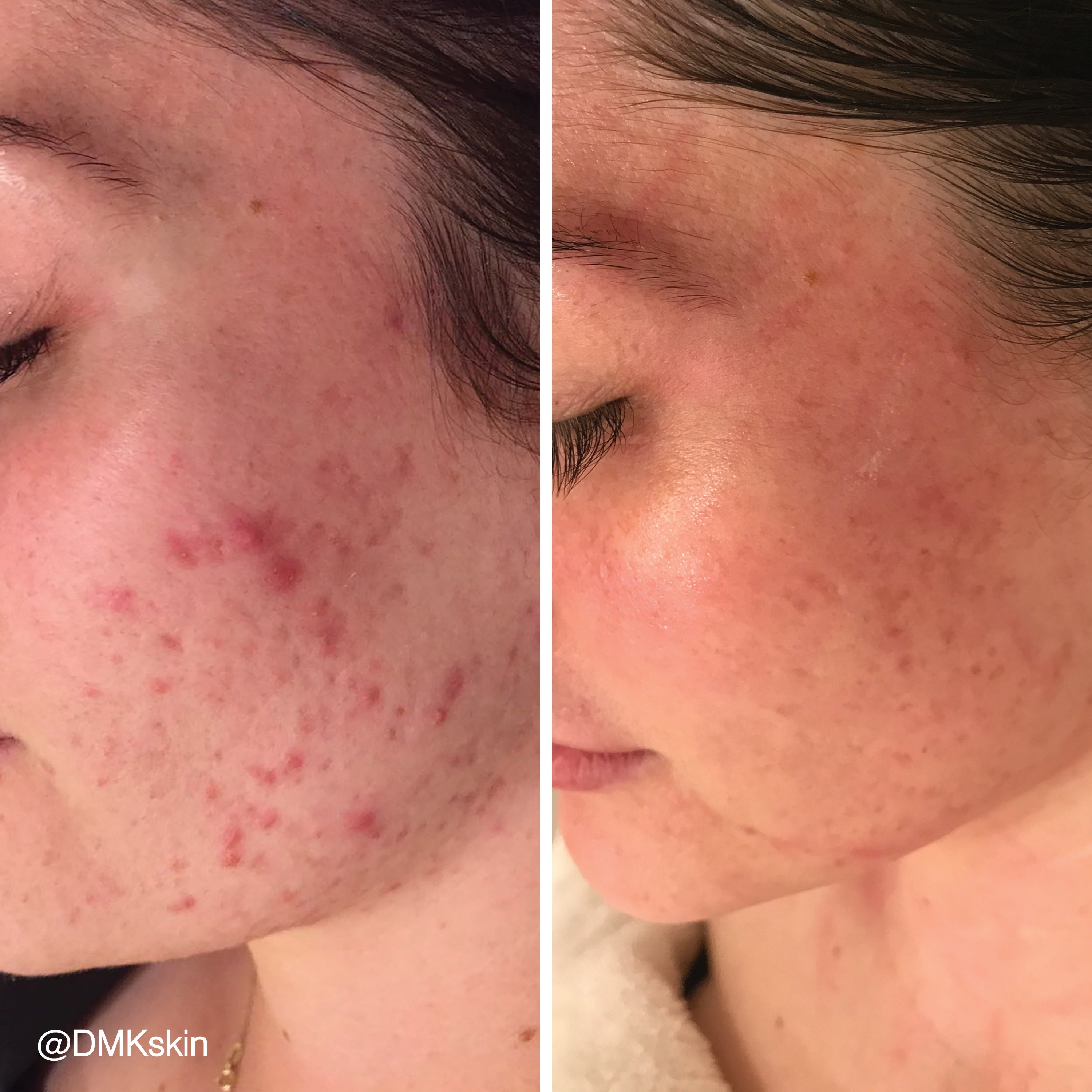 DMK Enzyme Facial - Level 2
