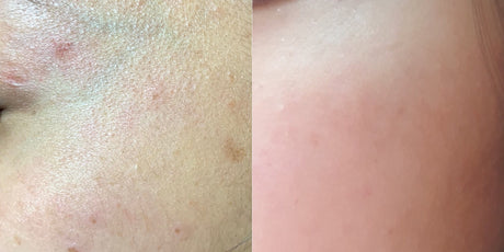 Pico Laser Skin Resurfacing