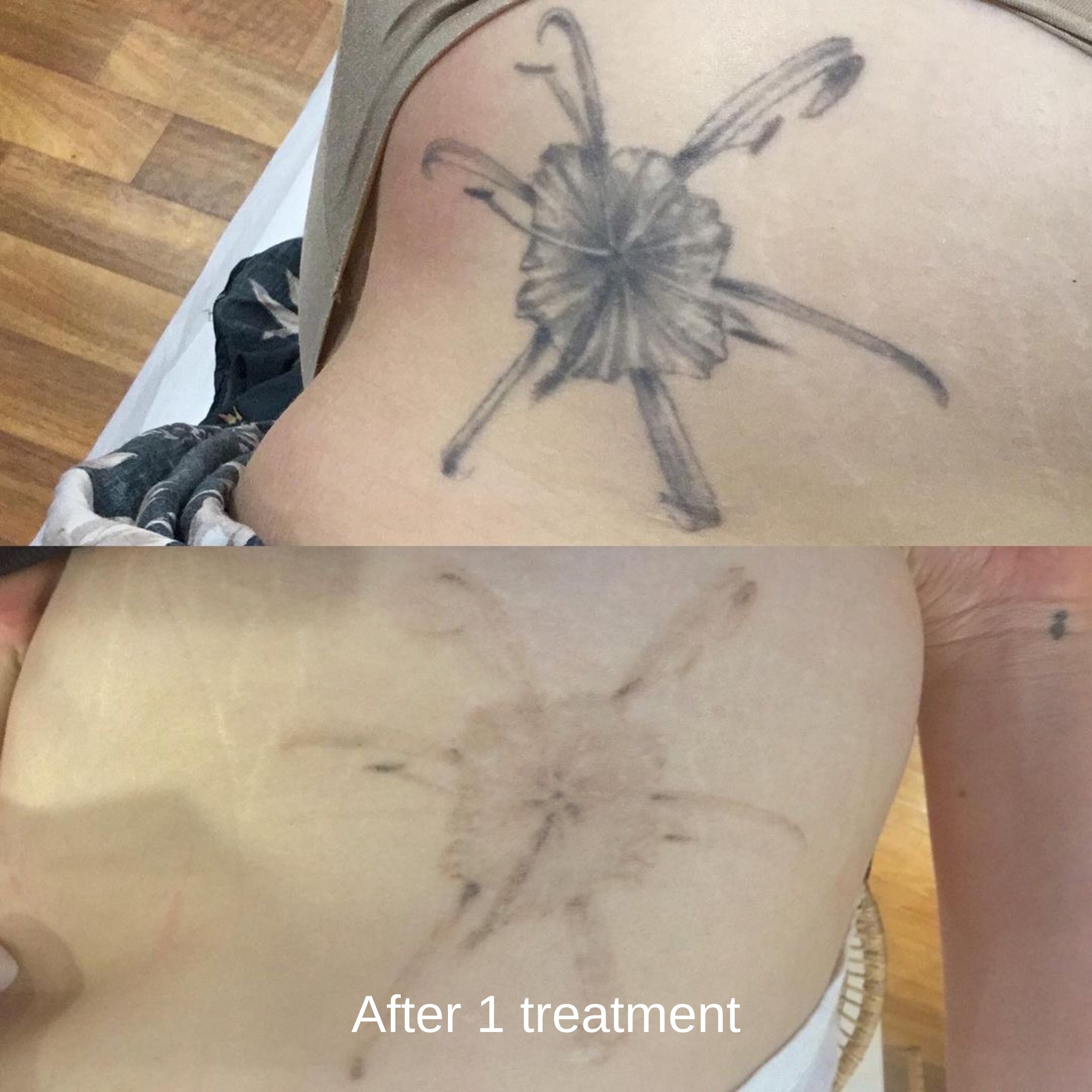 Pico Laser Tattoo Removal