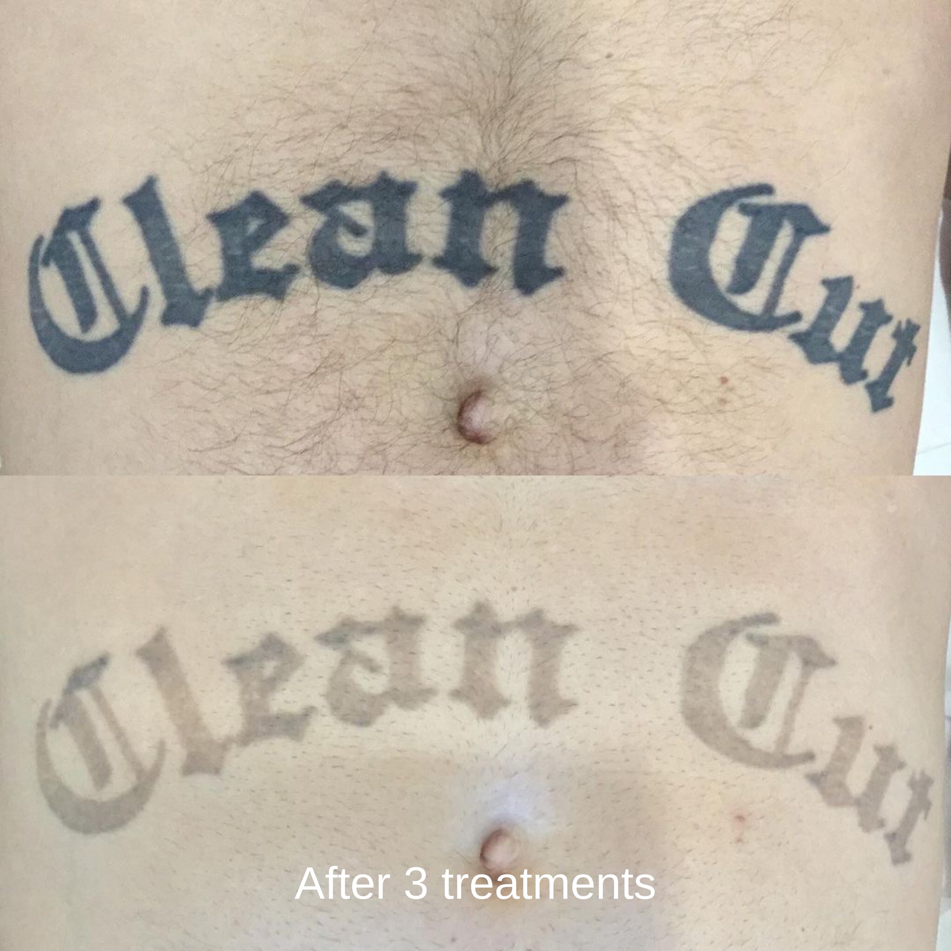Pico Laser Tattoo Removal
