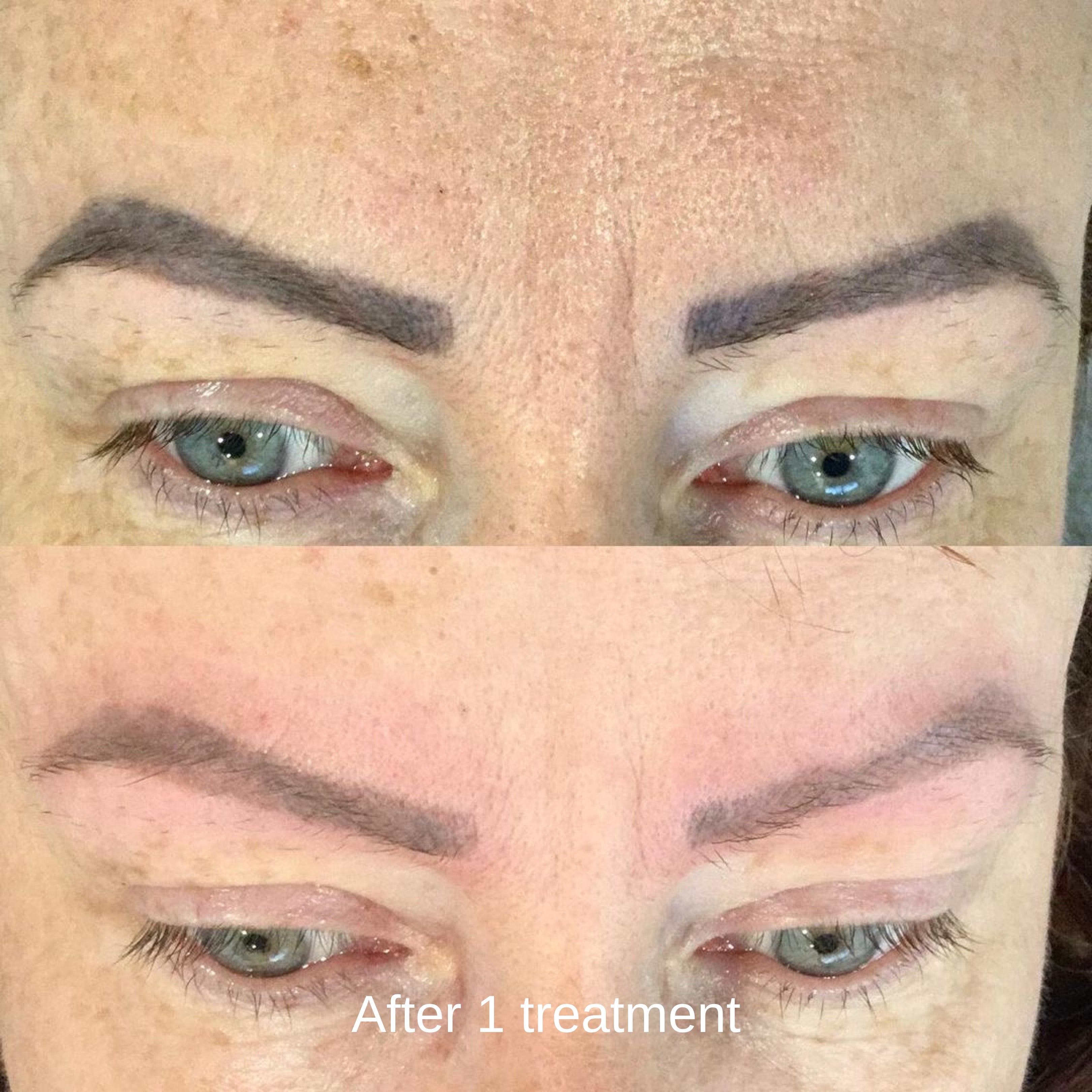 Pico Laser Tattoo Removal