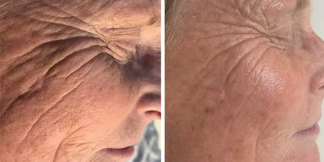Skin Needling + Enzyme Therapy - 90 mins