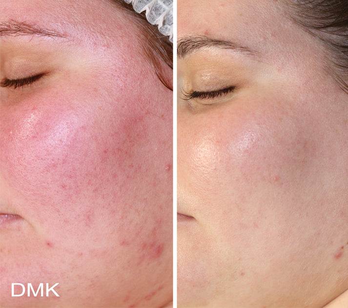 DMK Enzyme Facial - Level 1