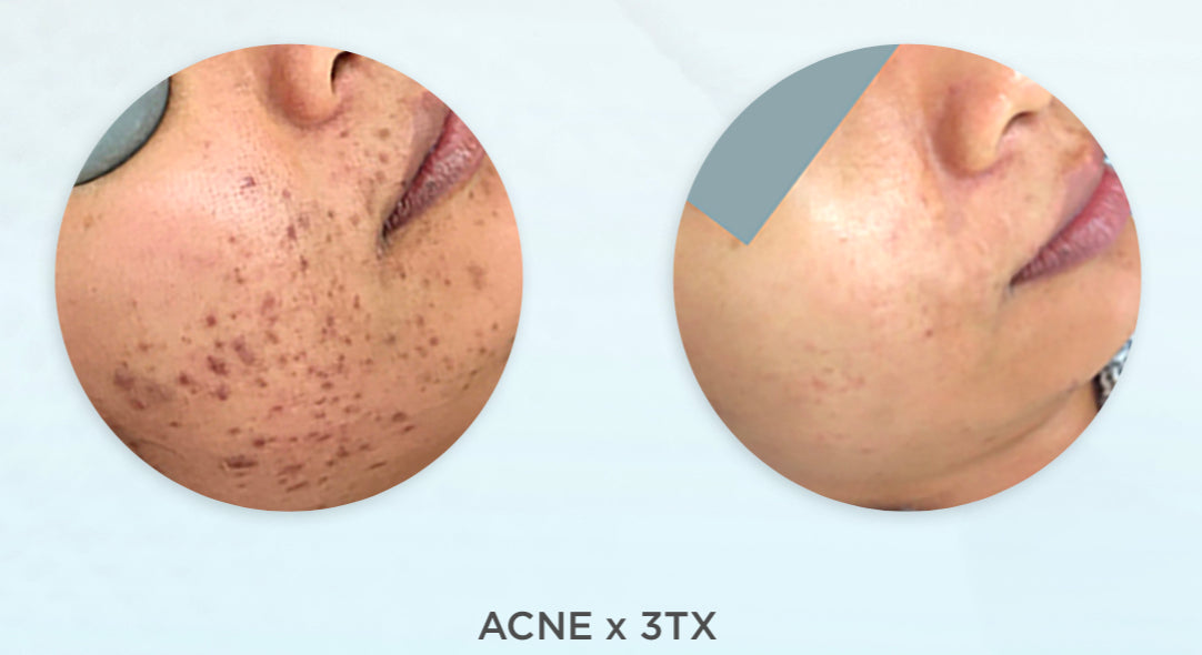 Dermapen Skin Needling