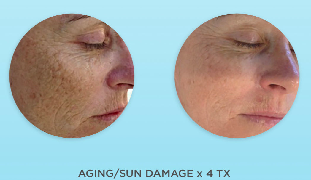 Dermapen Skin Needling