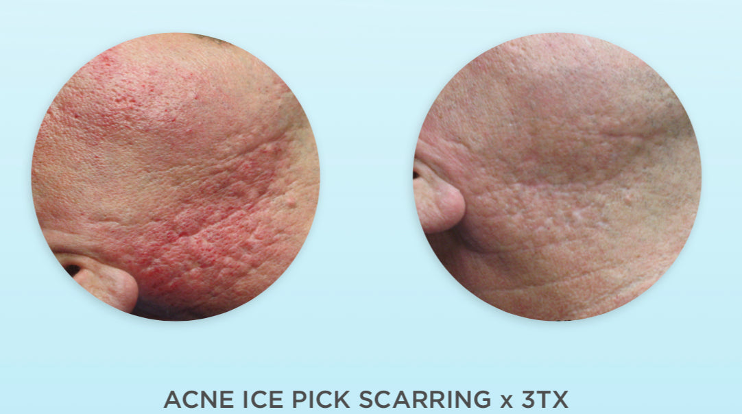 Dermapen Skin Needling