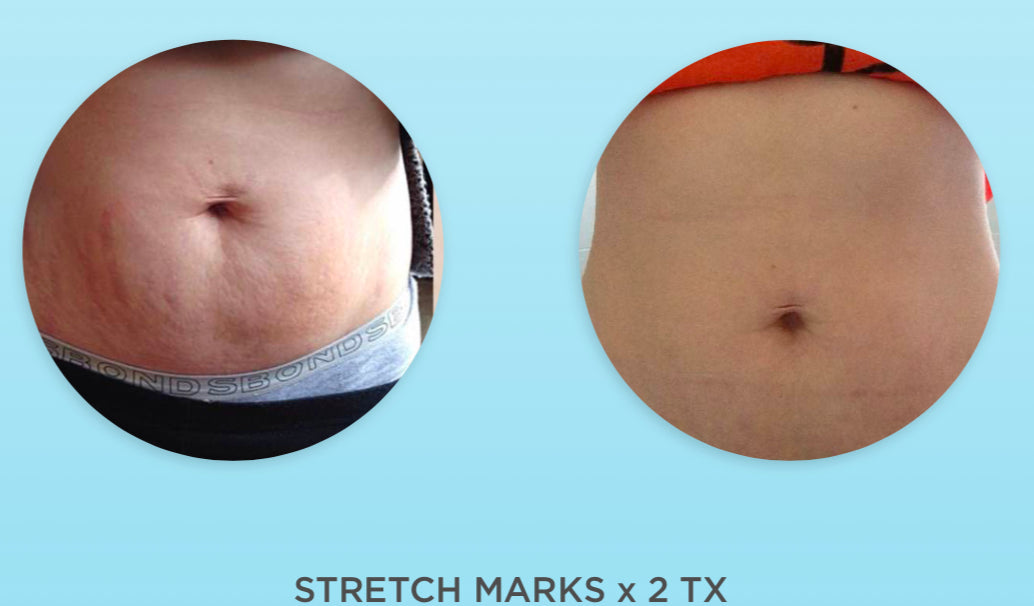 Dermapen Skin Needling