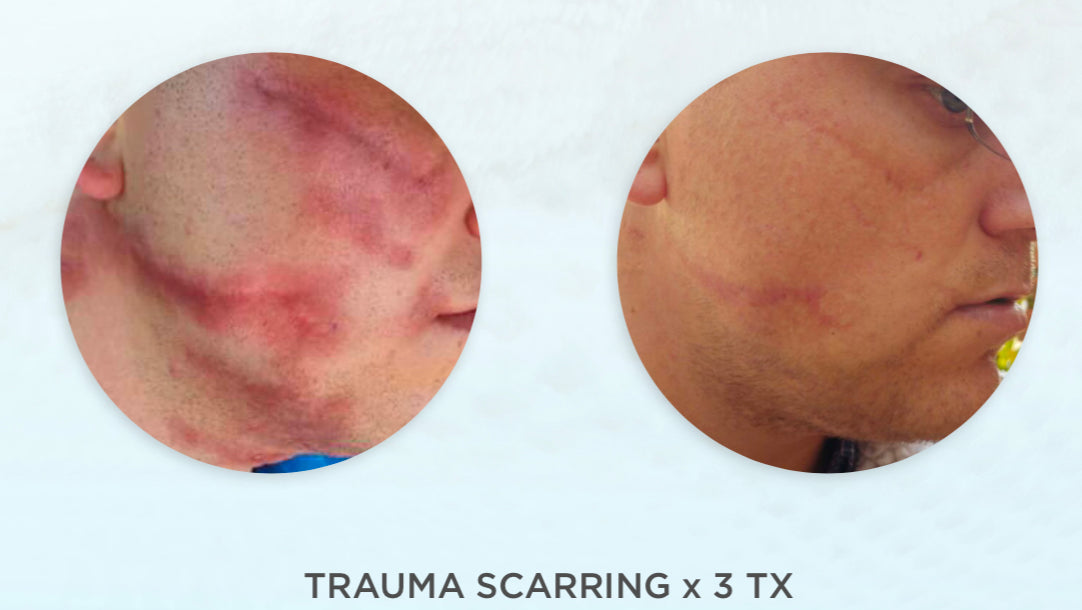 Dermapen Skin Needling