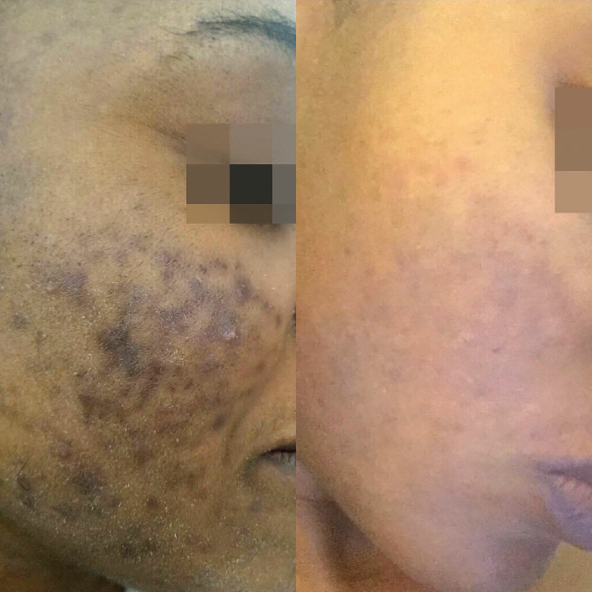 Cosmelan Pigmentation Treatment