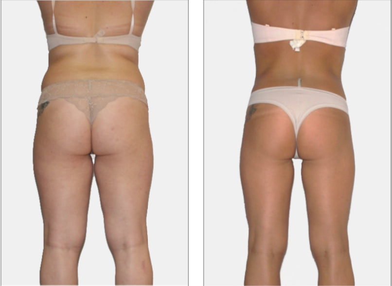 Endermologie Body Contouring