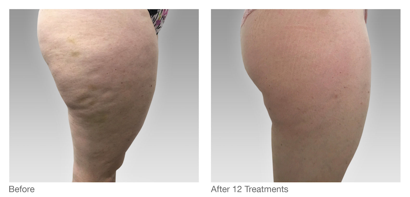 Fat Cavitation
