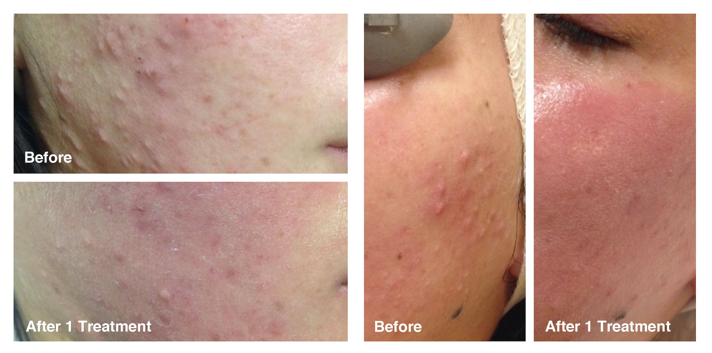 IPL Photo Rejuvenation