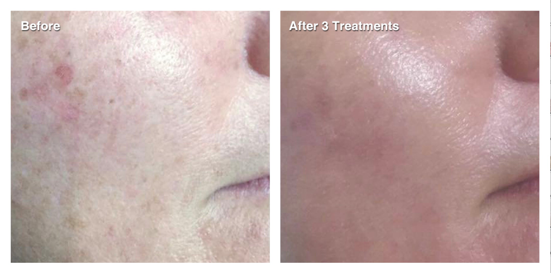 IPL Photo Rejuvenation