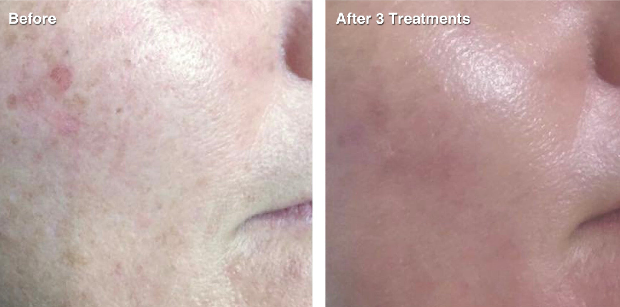 IPL Photo Rejuvenation