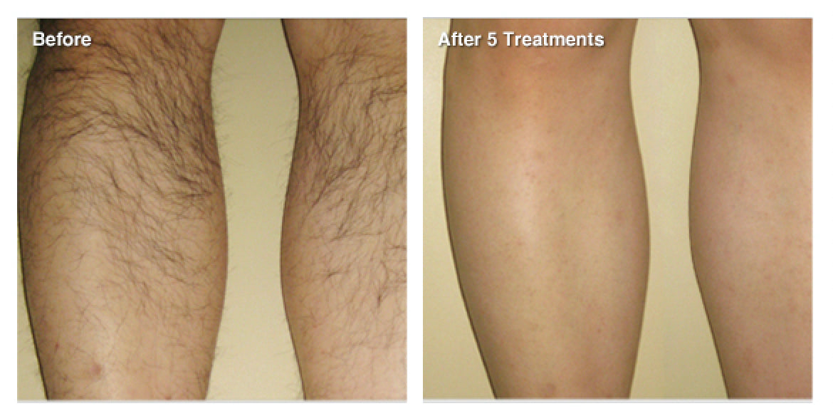 IPL Permanent Hair Reduction