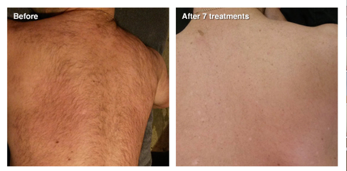 IPL Permanent Hair Reduction