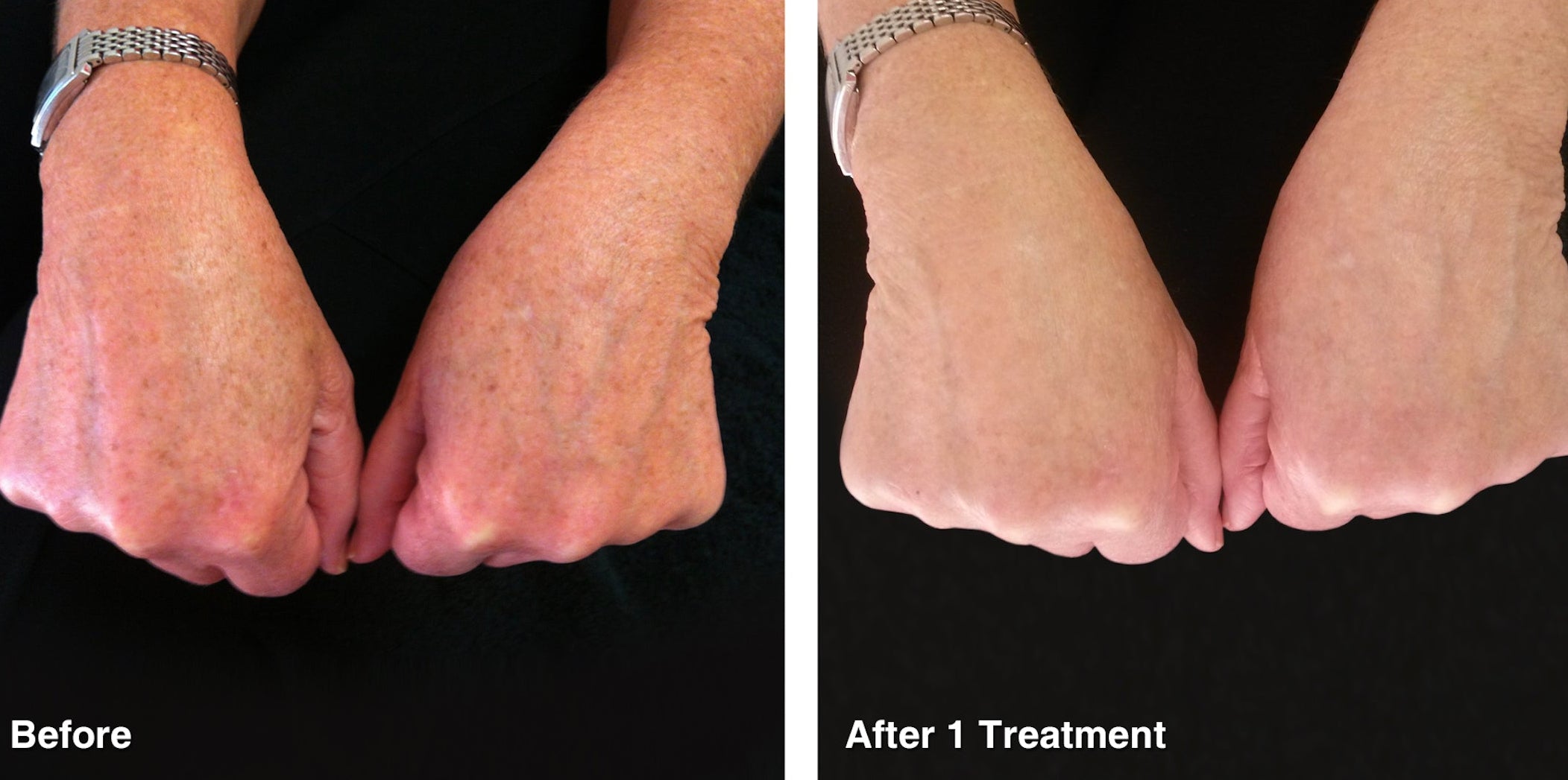 IPL Photo Rejuvenation