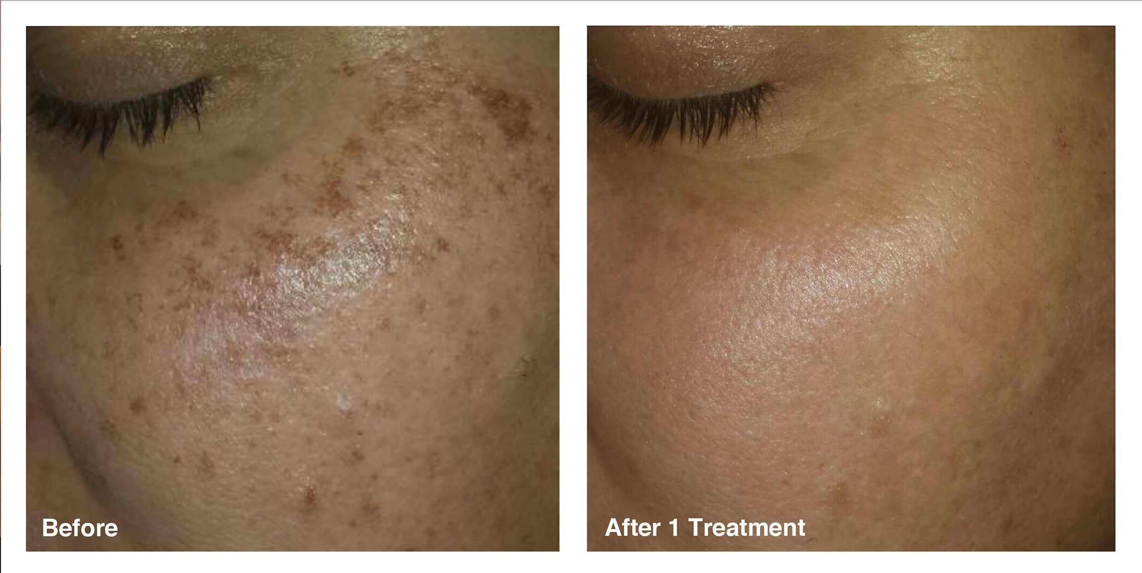 IPL Photo Rejuvenation