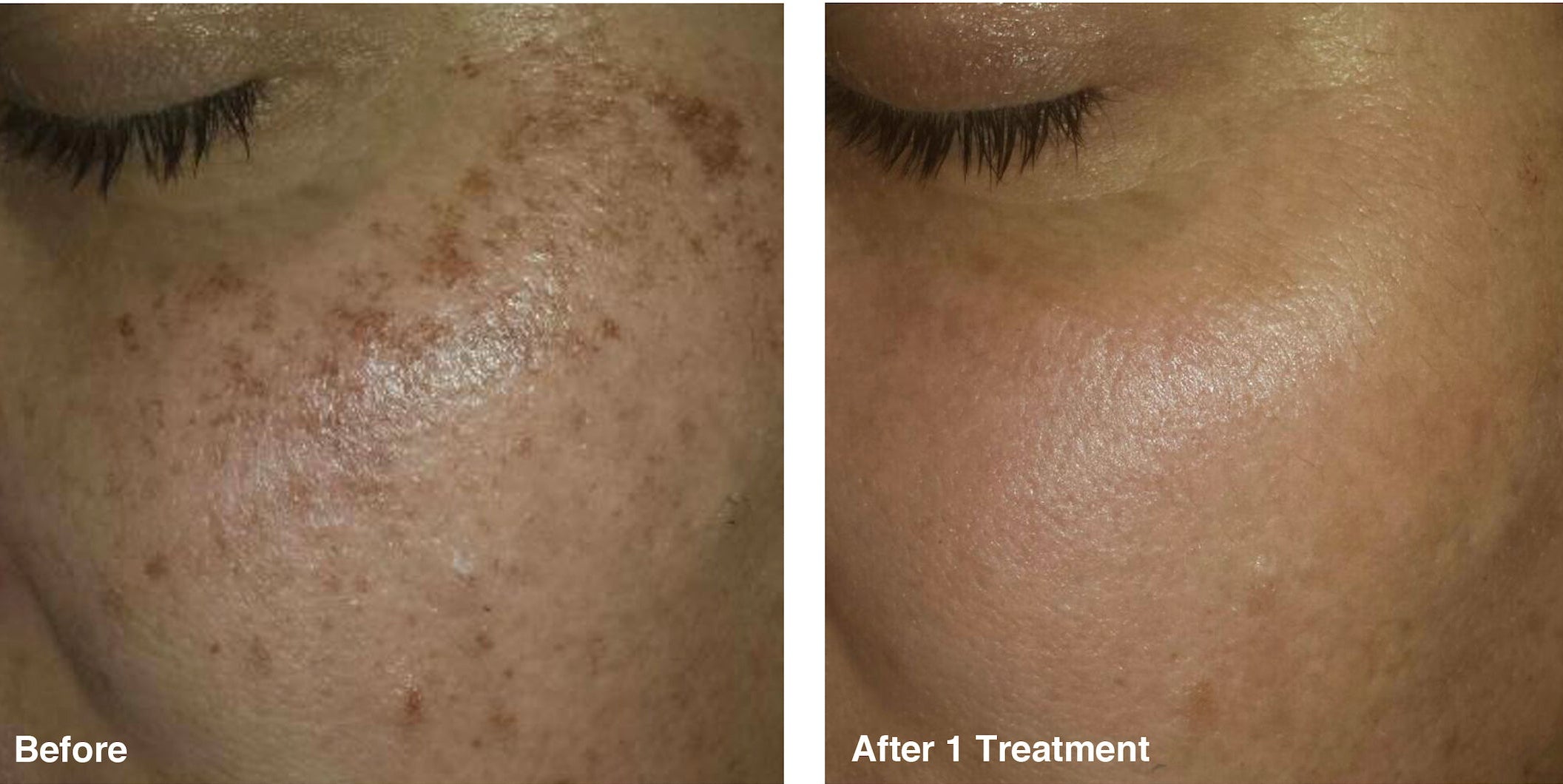 IPL Photo Rejuvenation