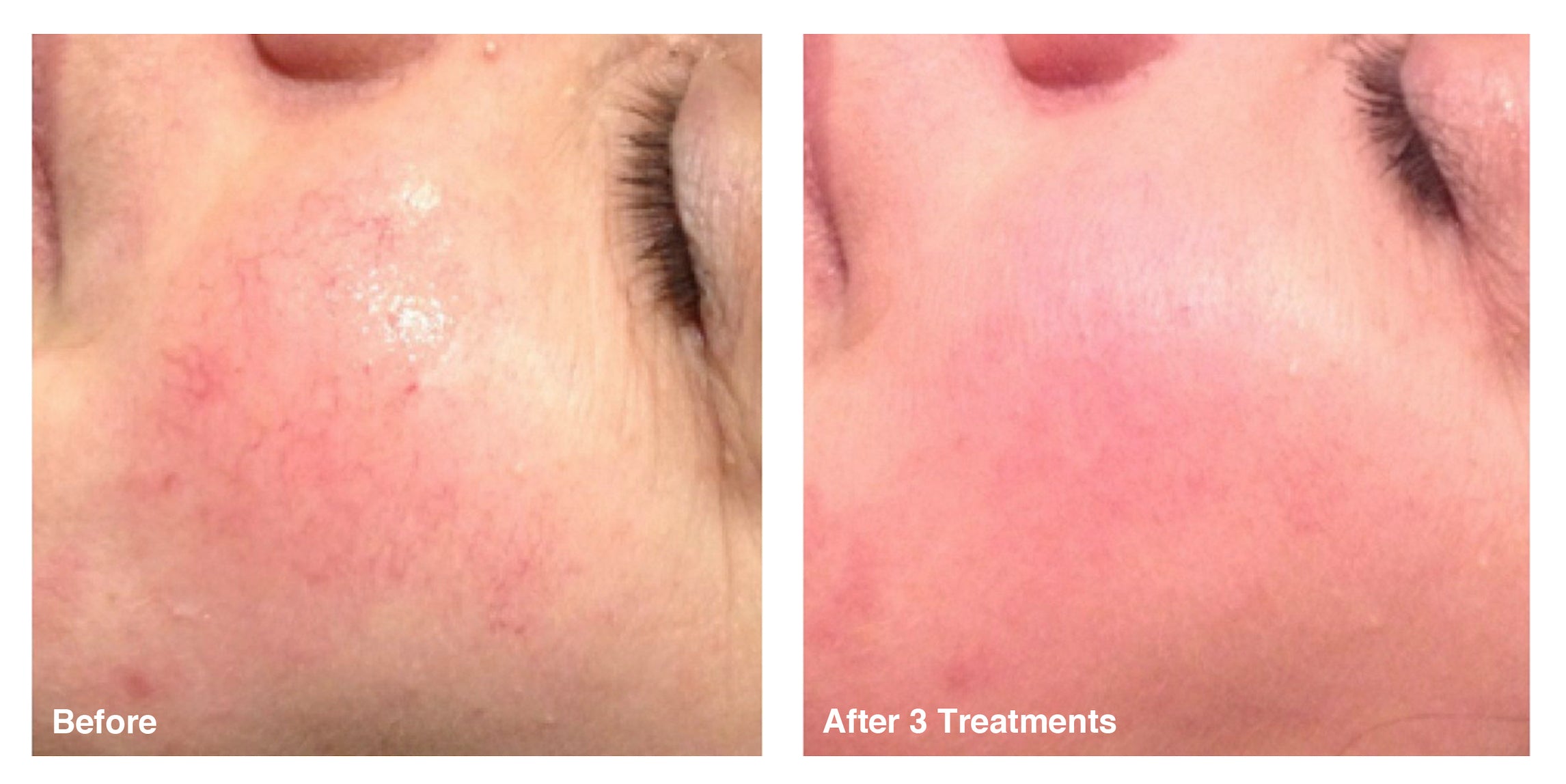 IPL Photo Rejuvenation