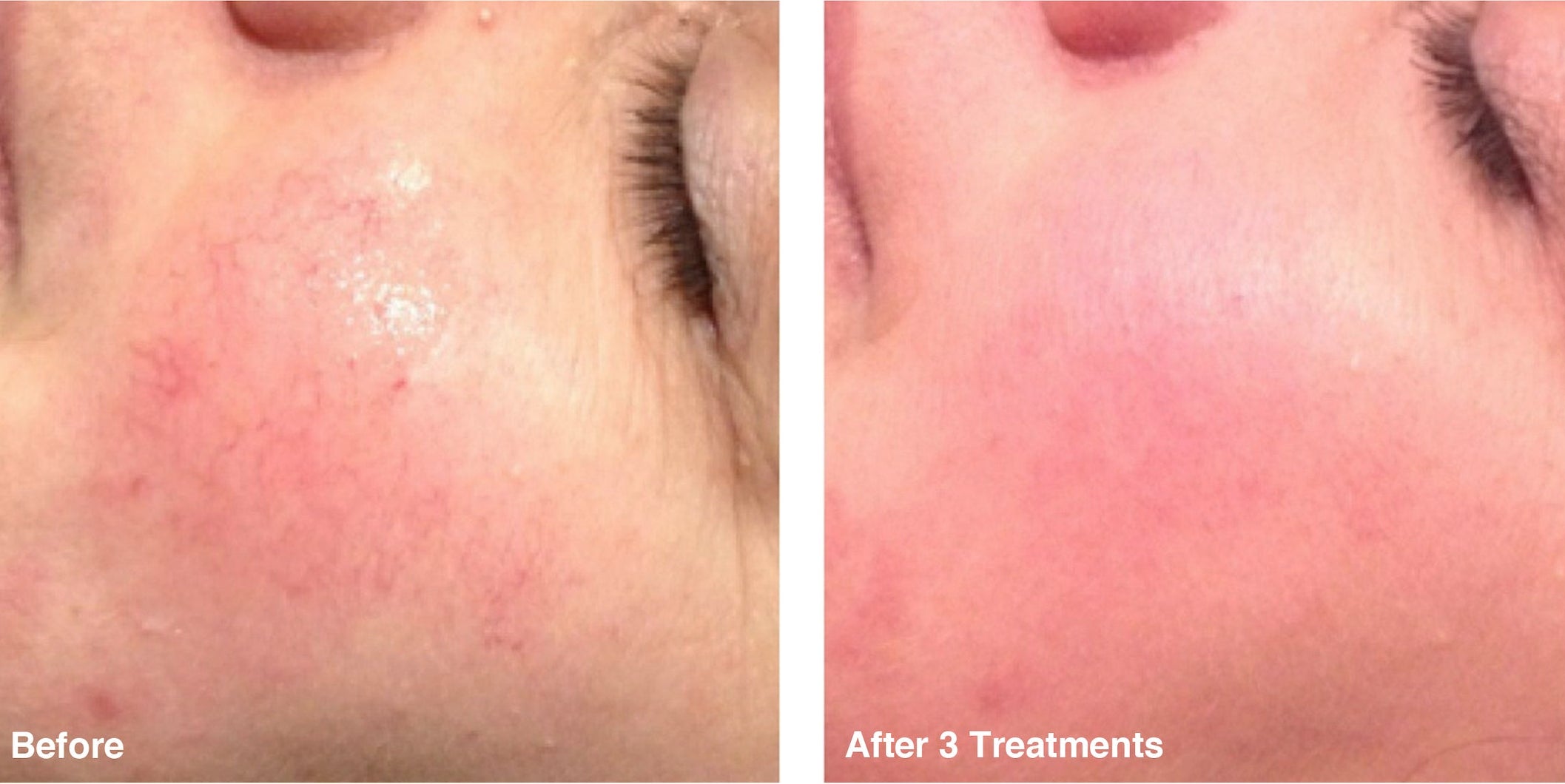 IPL Photo Rejuvenation