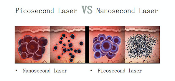 Pico Laser Tattoo Removal
